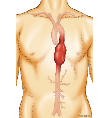 症状 腹部 大動脈 瘤