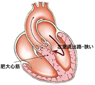 肥大型心筋症 HCM - 主な対象疾患 - 慶應義塾大学病院 心臓血管低侵襲 