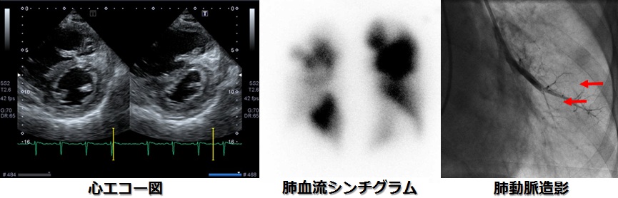 慢性血栓塞栓性肺高血圧症 主な対象疾患 慶應義塾大学病院 心臓血管低侵襲治療センター Keio University Medical Center For Minimally Invasive Cardiac Intervention 患者さんに優しく最適な最高水準の低侵襲治療を